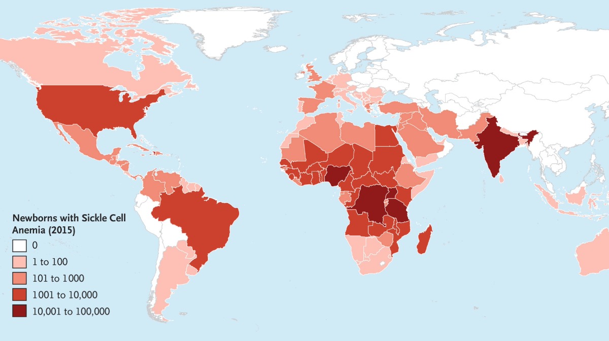 World map showing the prevalence of sickle cell anemia in newborns in 2015 using varying shades of red.